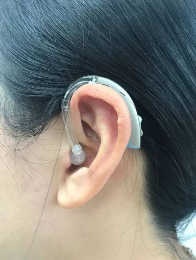 最新款人工耳蝸隱形，時(shí)代之聲的聽力革命