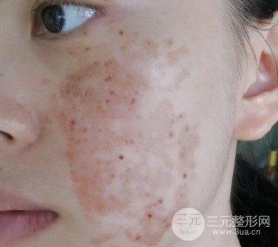 激光祛斑價(jià)格解析，探索與影響因素