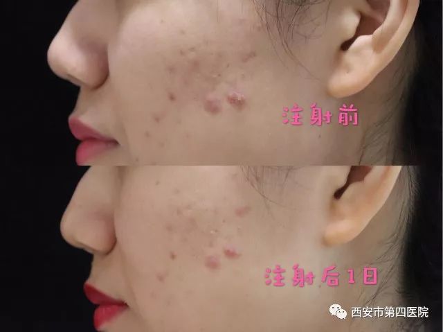 最新痤瘡治療技術(shù)，開啟美麗肌膚之門