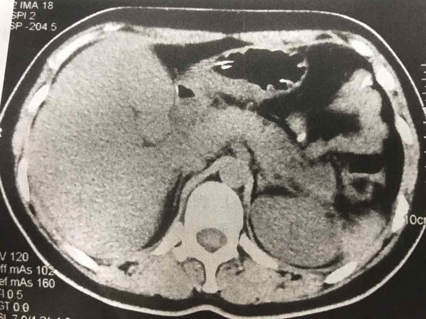 急性胰腺炎最新分型揭秘，一日之奇妙與疾病分型探索